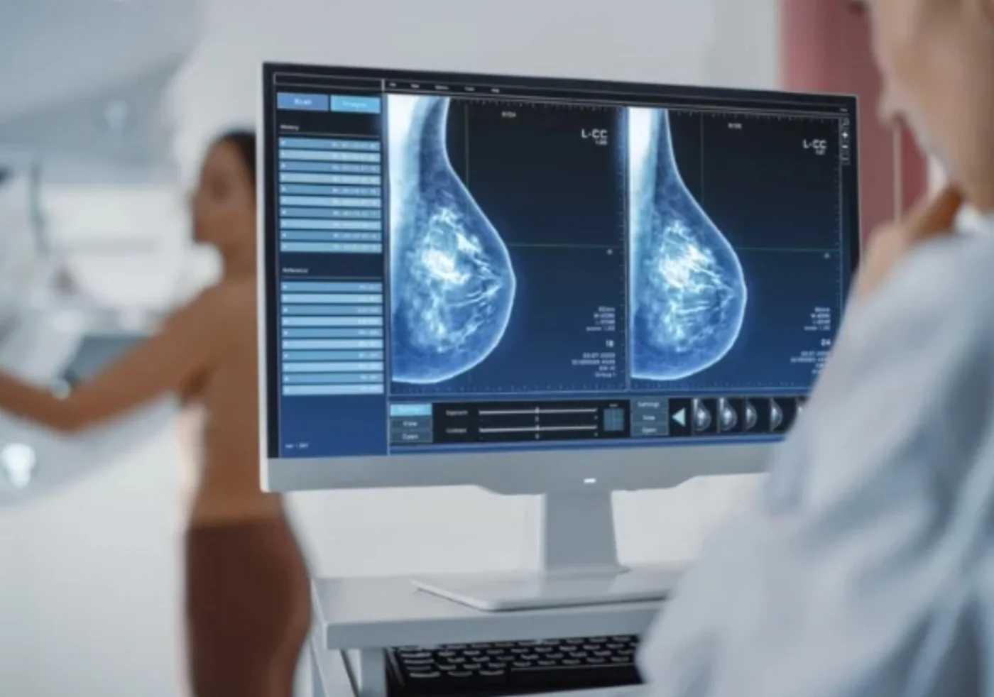 OncoView AI mammography triage view with Grad-CAM explainability overlay